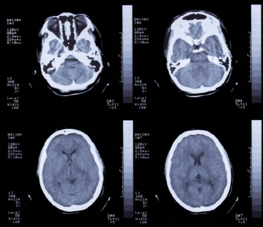 뇌 편도, 생명유지 숨 제어한다