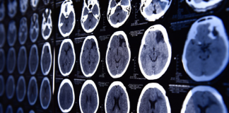 알코올로 손상된 뇌 금주 7개월 지나야 회복