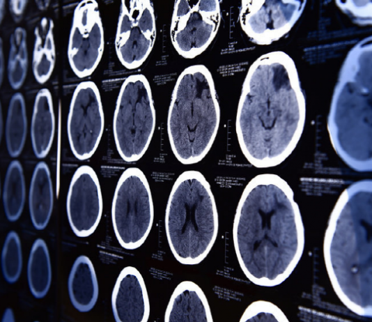 알코올로 손상된 뇌 금주 7개월 지나야 회복