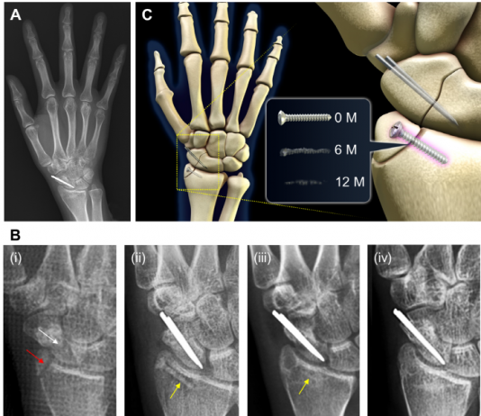 몸에 녹는 금속 나사, 골절치료 분야 새로운 장 열어
