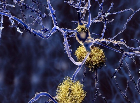 알츠하이머 치료 신약물 ‘아두카누맙’ 초기 치매 치료에 효과