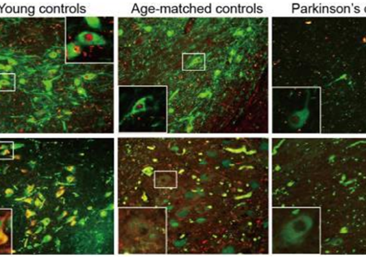 ‘PAK4 단백질’로 파킨슨병 진행 막는다