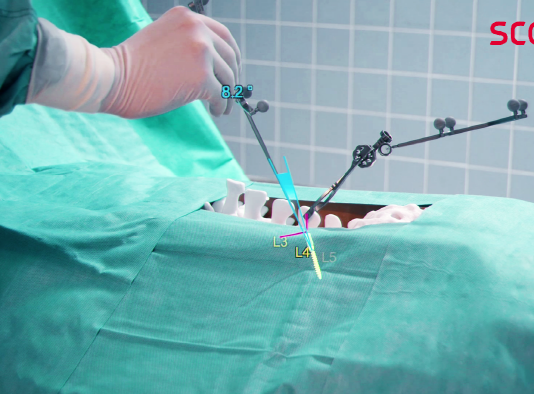 척추수술 용 홀로렌즈 플랫폼 나온다