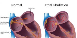 출시 되자마자 사용자 생명 구한 애플워치4 심전도 기능