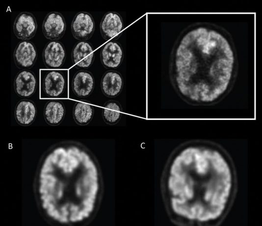 알츠하이머 치매, AI로 조기 진단 성공