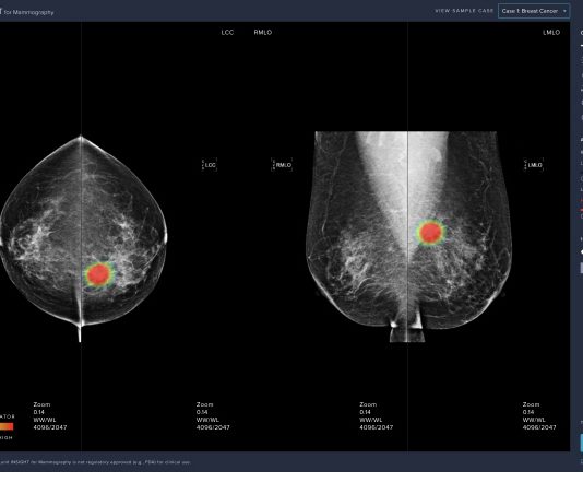 유방암 진단 AI 소프트웨어 ‘루닛 인사이트 MMG’ KFDA 허가