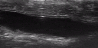 마이크로 로봇이 대장에 약물 운반 성공