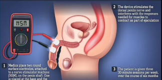 음경 전기자극으로 40초 조루증 5분으로 연장