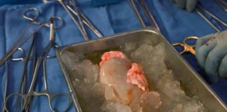 세계 최초 돼지 신장 이식 성공